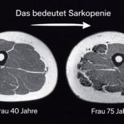 Vergleich MRT-Querschnitt Oberschenkel: Frau 40 Jahre mit hoher Muskelmasse vs. Frau 75 Jahre mit Sarkopenie und Fettinfiltration