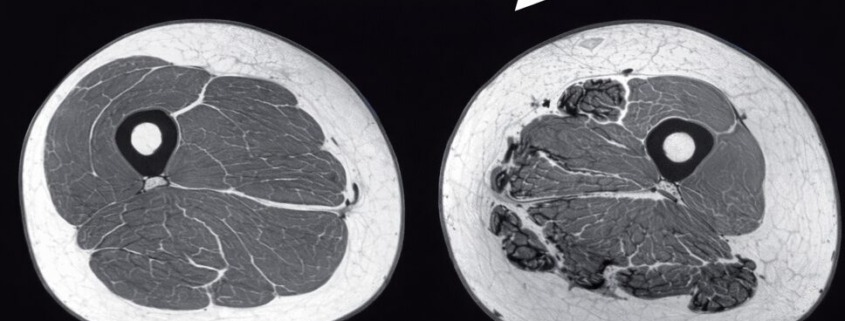 Vergleich MRT-Querschnitt Oberschenkel: Frau 40 Jahre mit hoher Muskelmasse vs. Frau 75 Jahre mit Sarkopenie und Fettinfiltration
